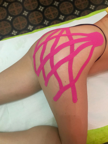 kinesio taping